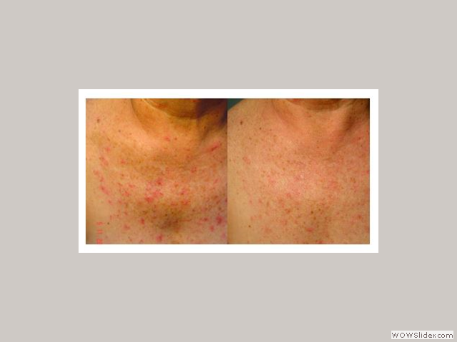 Laser Skin Treatment - Patient with VHC hepatitis and spider haemangiomas on the chest
