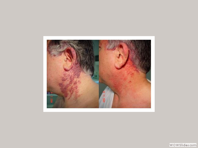 Laser Treatment - Patient with PWS