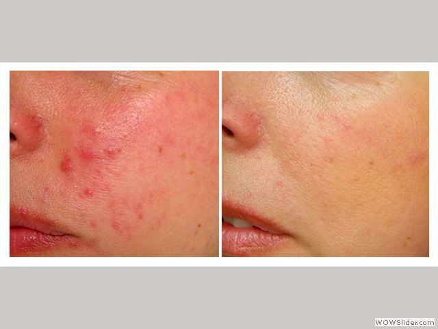 Laser Skin Treatment - Patient with rosacea
