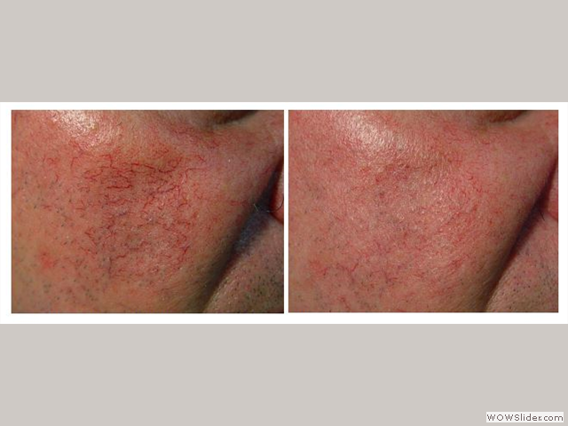 Laser Genesis - Patient with medium size telangiectasia on the face