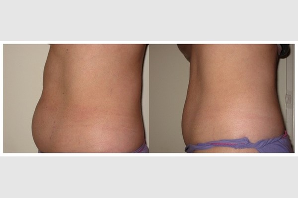 Body Contouring Treatment result 2