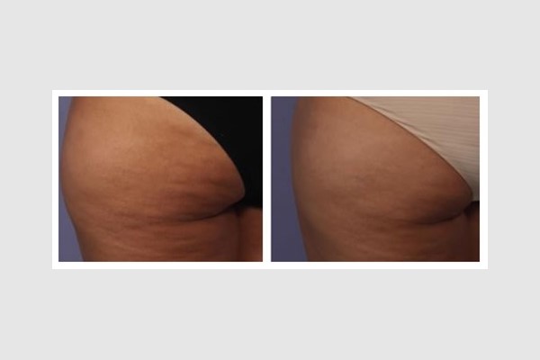 Body Contouring Treatment result 5