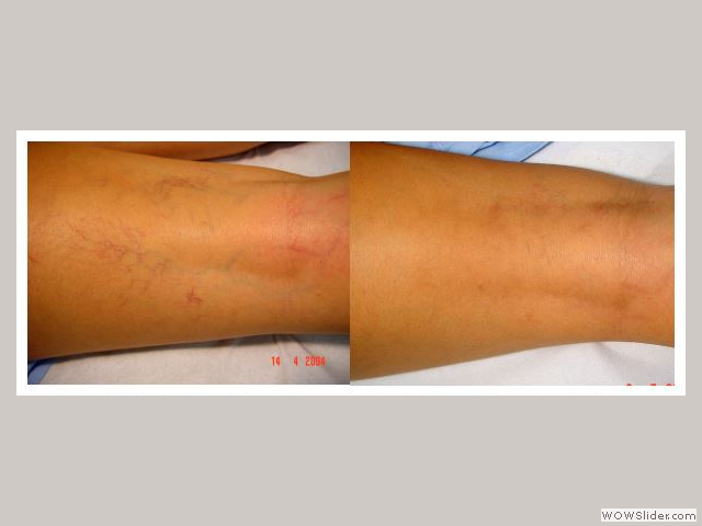 Patient with leg telangiectasia and veins