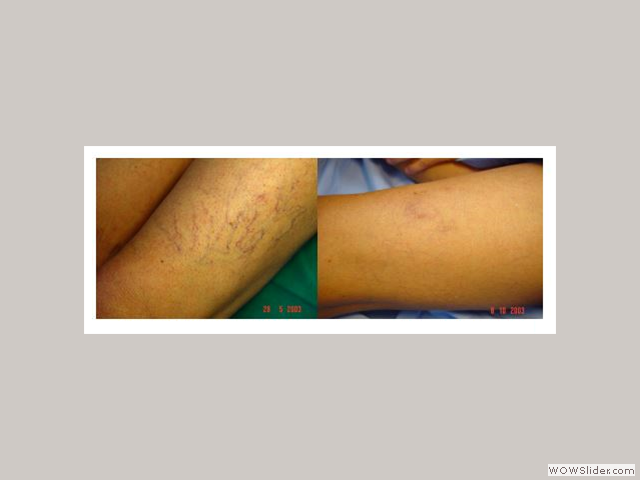 Patient with leg telangiectasia and veins