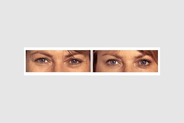 BOTOX and Dysport Crows Feet Treatment