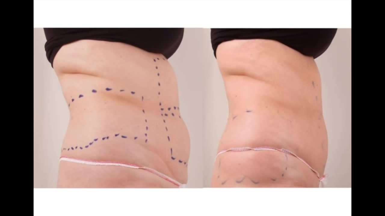 Body Contouring Treatment result 8