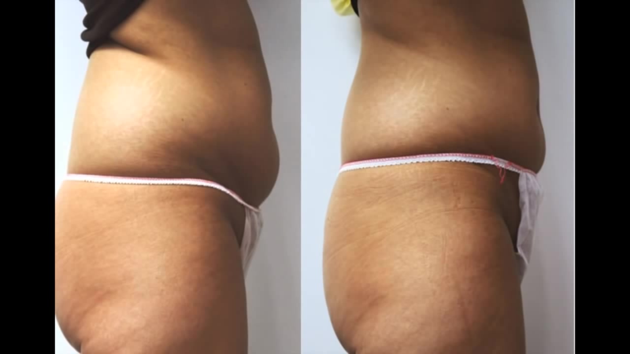 Body Contouring Treatment result 6