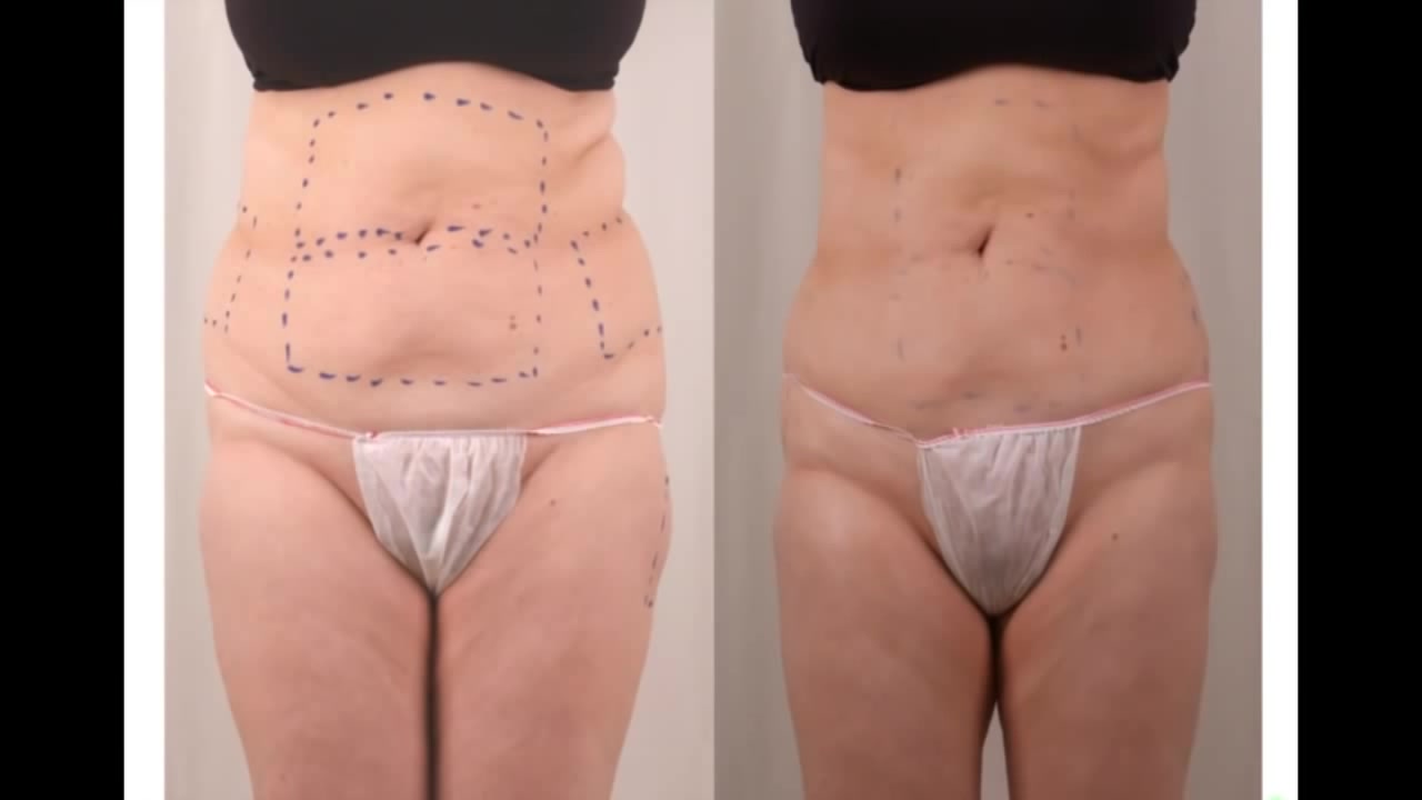 Body Contouring Treatment result 7