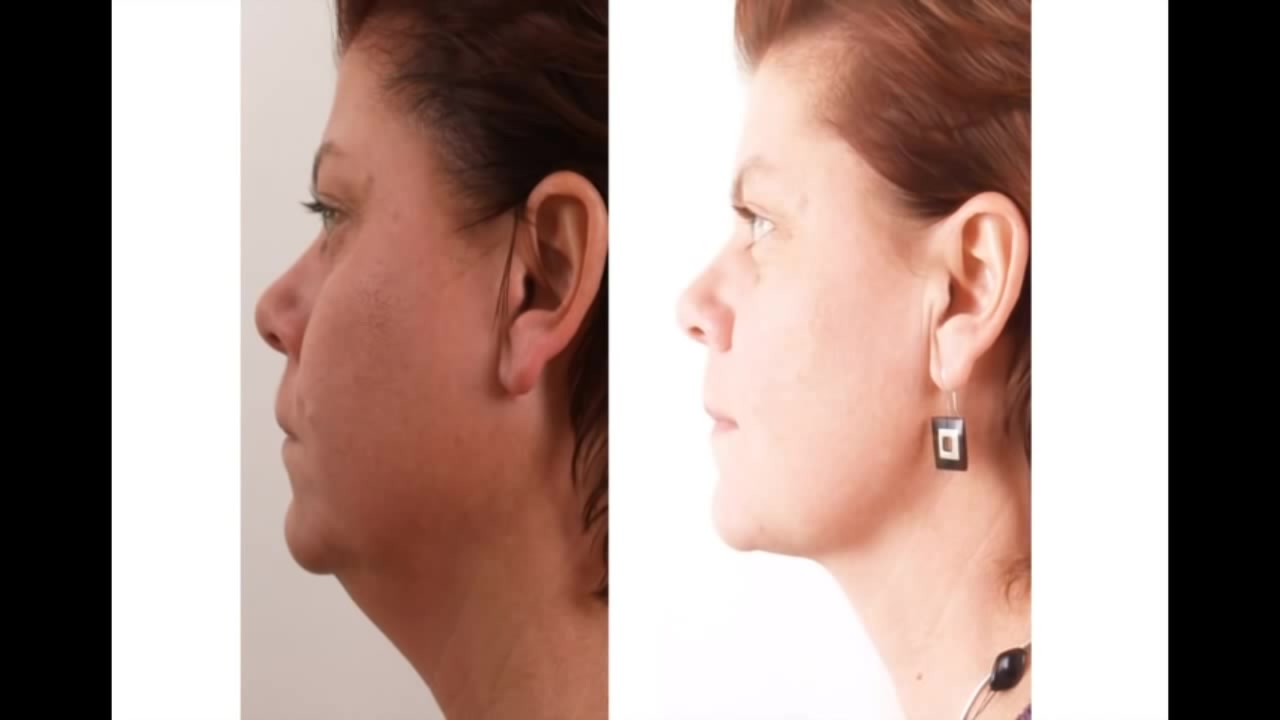 Skin Tightening Treatment face result 4