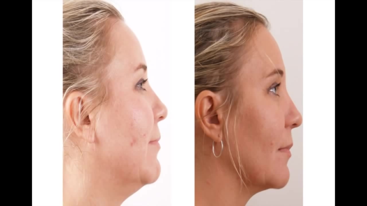 Skin Tightening Treatment face result 2