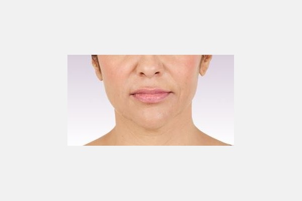 Tratamiento de lineas nasolabiales y área de la mejilla - Despues