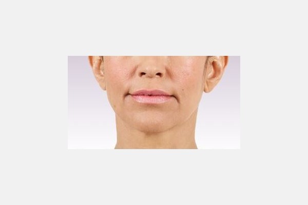 Tratamiento de lineas nasolabiales y área de la mejilla - Antes