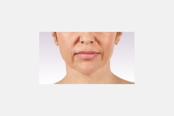Tratamiento de lineas nasolabiales y área de la mejilla - Despues